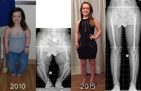 A Patient With Achondroplasia Dwarfism Before And After One Arm Lengthening And Two Leg