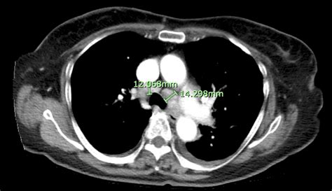 A Follow‐up Chest Abdomen And Pelvis Ct Scan With Contrast Showing Download Scientific