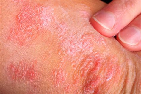 Skin Diseases Case Study 紐約中醫