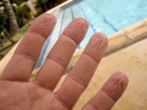 Кожа морщится от воды на пальцах рук Реакция организма на воду