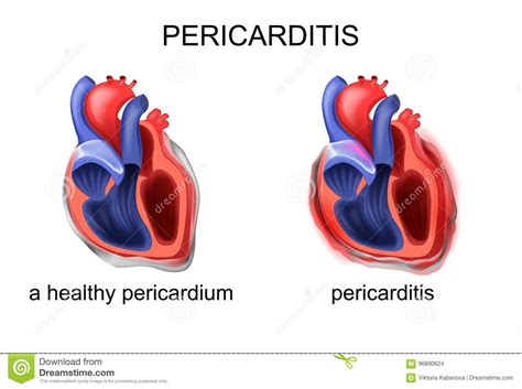 Avvii di pazienti e viitatori | informazioni generali se si sospetta la pericardite, l'operatore sanitario ascolterà il tuo cuore con molta attenzione. Un Pericardio Sano, Pericardite Illustrazione Vettoriale ...