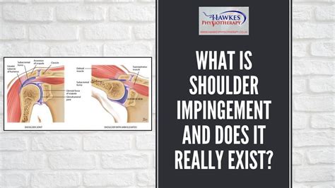 What Is Shoulder Impingement And Does It Really Exist