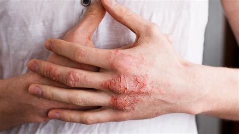 Its Not Itch Its Pain National Eczema Association