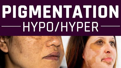 Difference Between Hyperpigmentation And Hypopigmentation Youtube