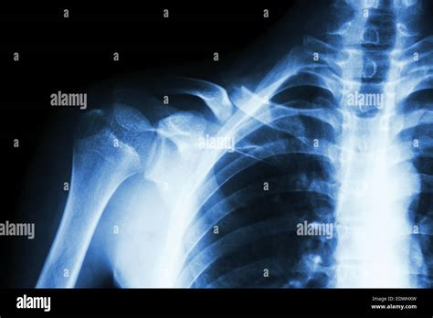 Film X Ray Right Claviclecollarbone Show Fracture Right Clavicle