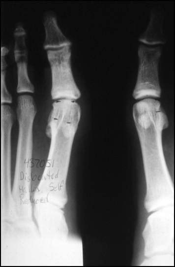 Sesamoid Injuries Of The Hallux Foot And Ankle Orthobullets
