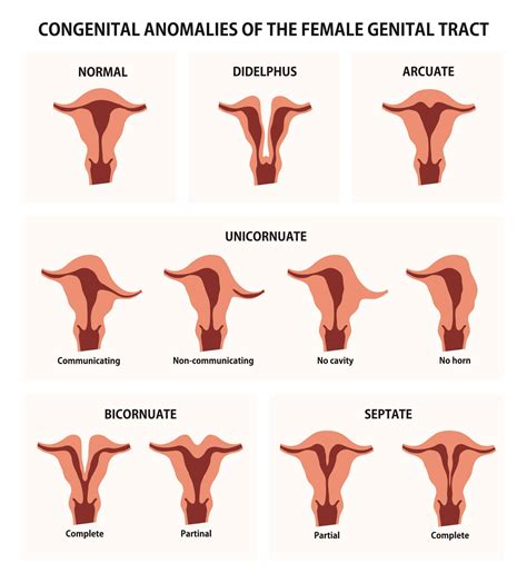 Uterine Anomalies Ob Gyn New York Gynecologists In New York