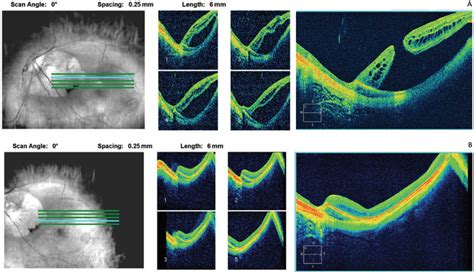 Retinal Tear Oct