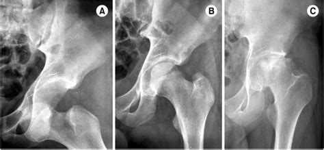 An Anterior Hip Dislocation A Was Reduced Closely B However Download Scientific Diagram