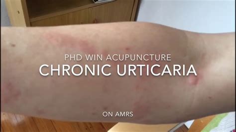 Treated Chronic Urticaria With Herbs And Acupuncture Youtube