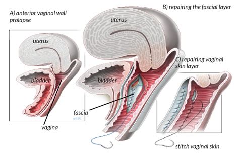 Anterior Vaginal Repair Your Pelvic Floor