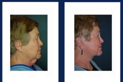 Facelift Holzapfel Lied Plastic Surgery