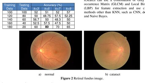 Figure 2 From Cataract Detection In Retinal Fundus Image Using Gray