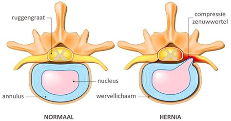 An inguinal hernia occurs when tissue, such as part of the intestine, protrudes through a weak an inguinal hernia isn't necessarily dangerous. Wat is een hernia of discushernia? | Dorsoo