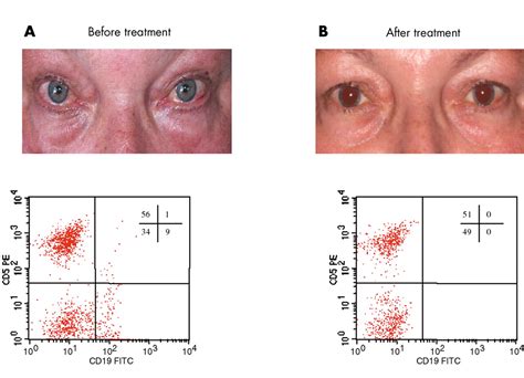 Successful Treatment Of Refractory Anterior Scleritis In Primary