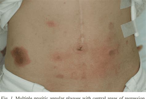 Figure 1 From Eosinophilic Cellulitis In A Patient With Gastric Cancer