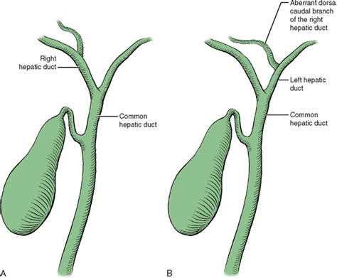 Left Hepatectomy Basicmedical Key