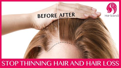 Stop Hair Falling Out In Clumps And Thinning Youtube