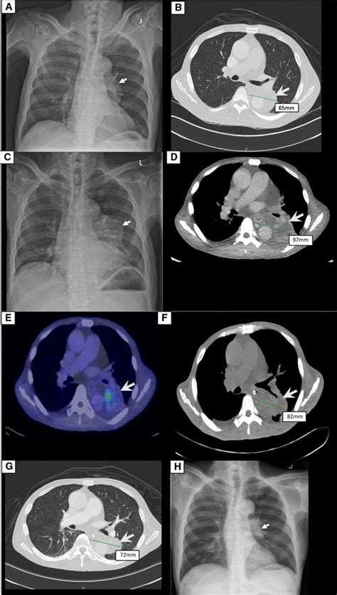 Serial Radiological Progress A Initial Chest Radiograph At