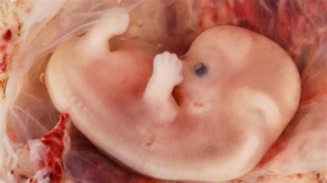 ectopic fetus removed  woman   years iflscience