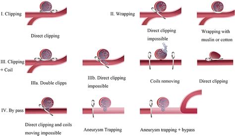 Frontiers Surgical Clipping Of Previously Coiled Recurrent