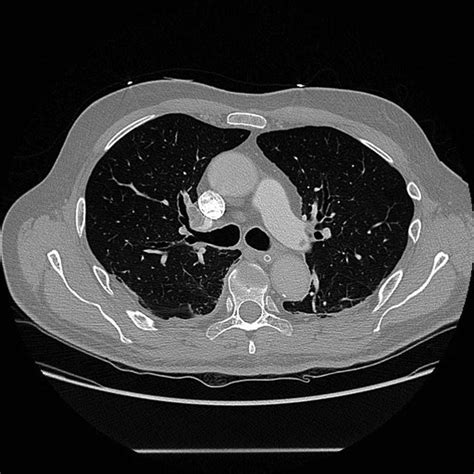 Ct Pulmonary Angiogram Showing Bilateral Pulmonary Embolism Download Scientific Diagram