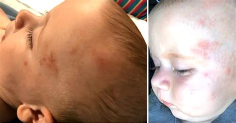 Six Month Old Boy Suffered A Brain Bleed And Severe Bruises On Head