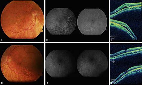 Ad Color Retinography Of Both Eyes In Which Posterior Staphyloma And