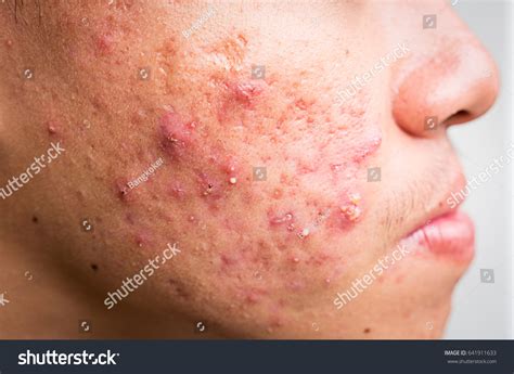 Close Hormonal Acne Man Face Right Stock Photo Edit Now 641911633