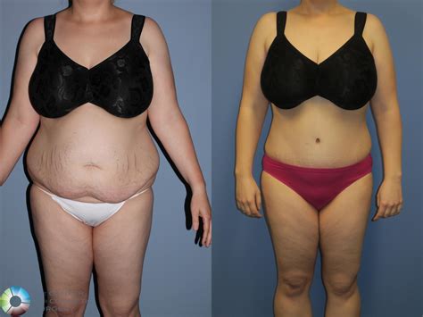Ricevere Dominio Sbagliato Full Body Liposuction Before And After