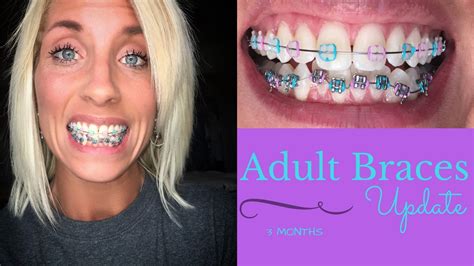 I know this is a normal process of getting the braces, but does anyone know anything that will make it stop? "ADULT BRACES" | 3 Months - Metal Braces on Bottom? - YouTube