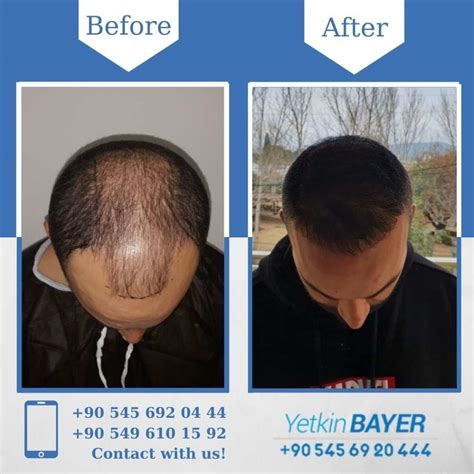 DHI Hair Transplant In Istanbul Turkey Reviews Prices 2024 Dr