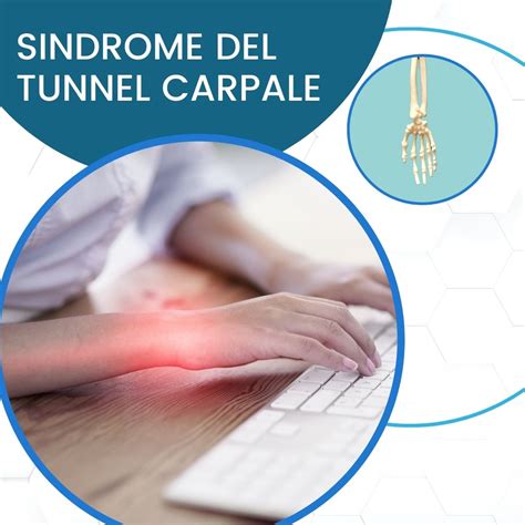 Sindrome Del Tunnel Carpale Sintomi Cause E Rimedi Vivere Al Meglio