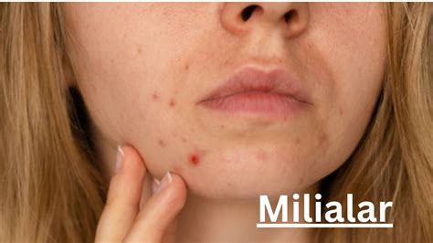 Milialar A Common Skin Disease Quiteinfo