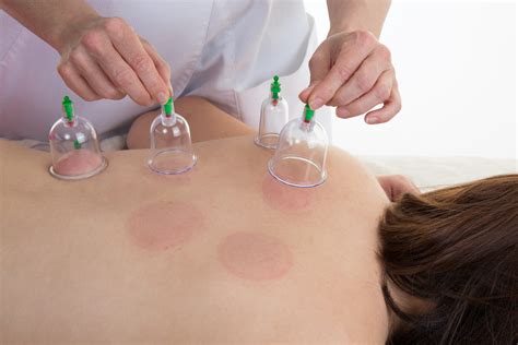 Using Cupping Therapy To Treat Severe Shoulder Pain Koshas Koshas