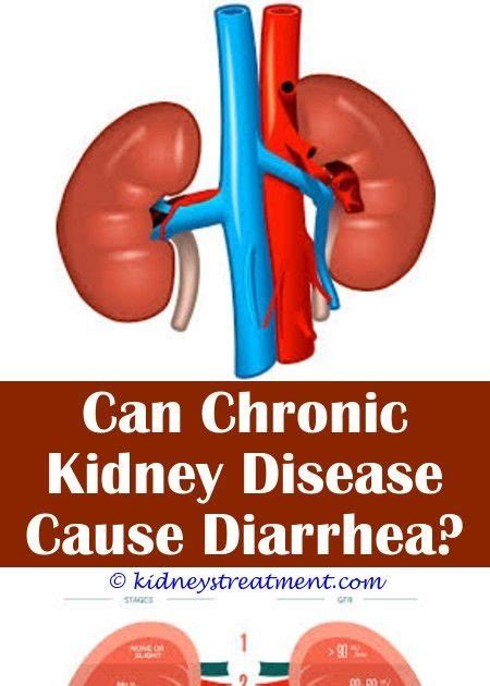 Can Kidney Stones Cause Constipation Or Diarrhea