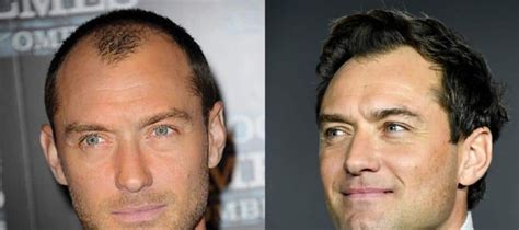 Of The Most Successful Celebrities Hair Transplants Natural Hair