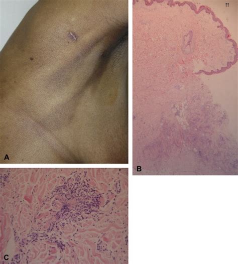 Palisaded Neutrophilic Granulomatous Dermatitis Associated With