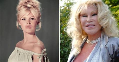 10 Epic Celebrity Plastic Surgery Disasters Mixtrends