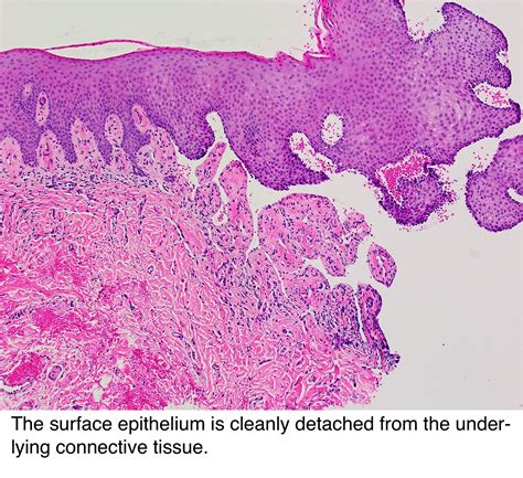 Pathology Outlines Pemphigoid