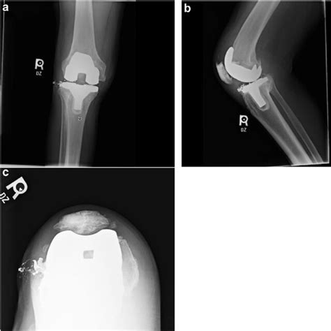 A Bilateral Skyline And B Lateral Radiographs Of Knees At 12 Week