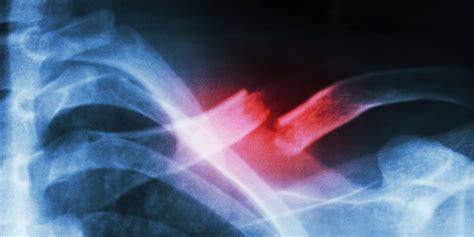 Three Stages Of The Broken Collarbone Treatment For Mountain Bikers