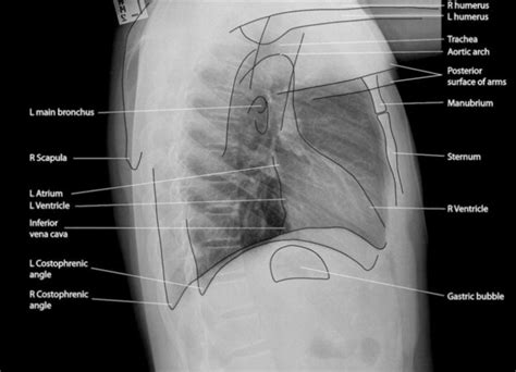 Normal Labelled Chest X Ray With Cardiovascular Structures