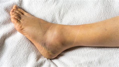Sprained Ankle Symptoms Diagnosis Physical Therapy
