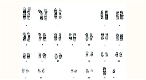 A Karyotype Showing The Philadelphia Chromosome Mccann S Foá R Smith