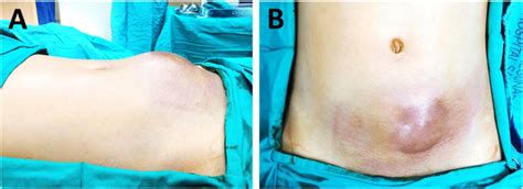 Lower Abdominal Wall Swelling Associated With Overlying Skin Contusion