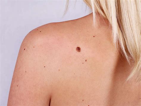 Skin Cancer Symptoms Of Skin Cancer