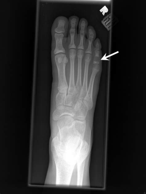 X Ray Of The Right Foot Case No 1 Showing A Radioluc Open I