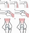 A new all-suture tension band tape fixation technique for simple ...