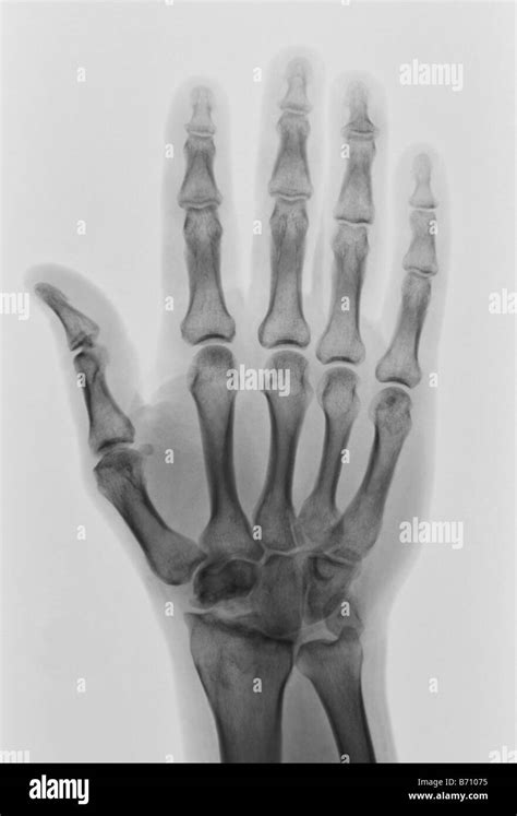 X Ray Normal Hand Hi Res Stock Photography And Images Alamy